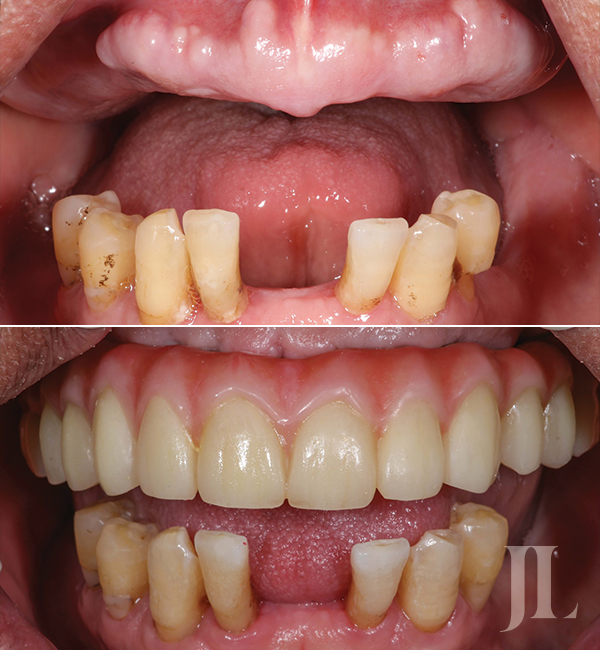 All-on-6 dental treatment before and after