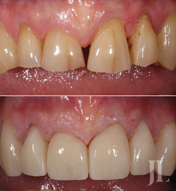 Dental crowns before and after
