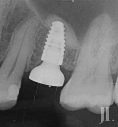 Dental implant shown on x-ray