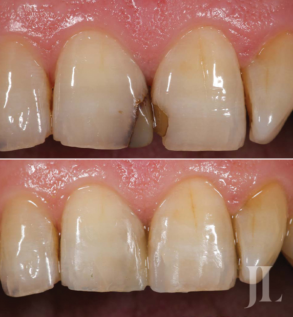 Smile restoration before and after