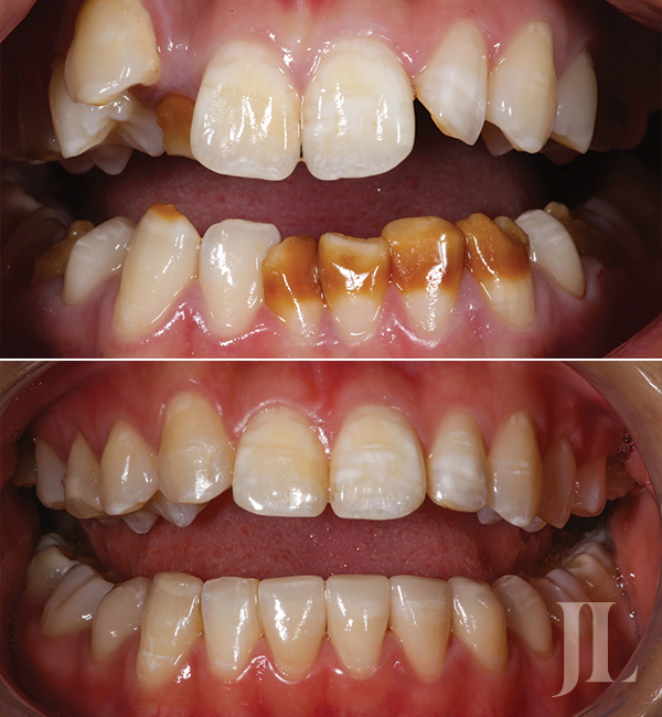 Smile restoration before and after