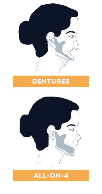 Dentures vs all-on-4
